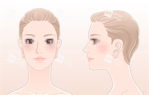 隆鼻手术对比