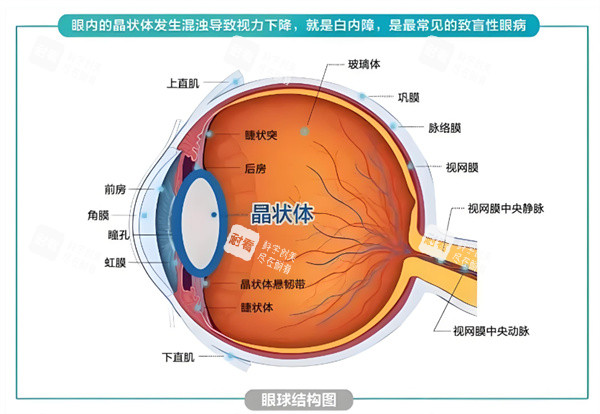白内障手术插画图片