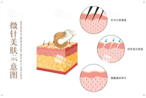 黑曜双波黄金微针是什么