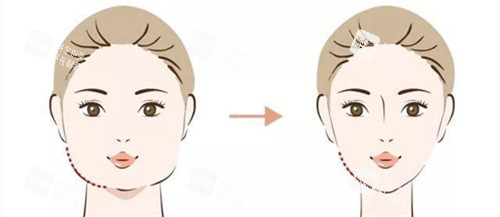 瘦脸手术前后对比动画图