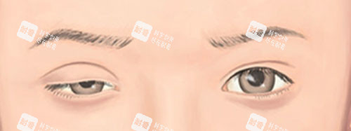 眼睑下垂术前术后