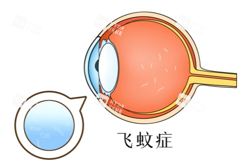 飞蚊症图片展示