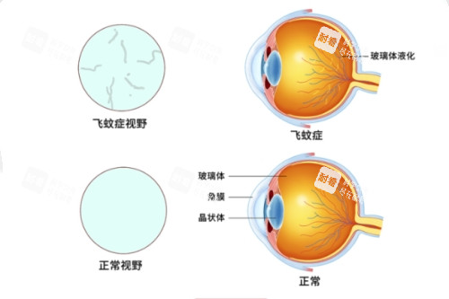 飞蚊症视野和正常视野对比