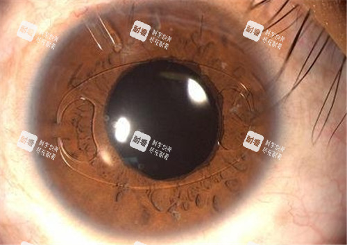 飞蚊症眼睛照片