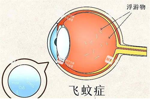 飞蚊症图