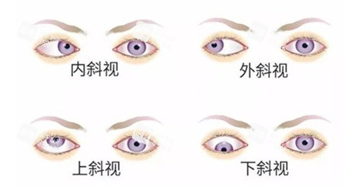 内外斜视、上下斜视