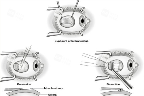 斜视手术过程