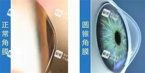 圆锥角膜和正常角膜的区别图解