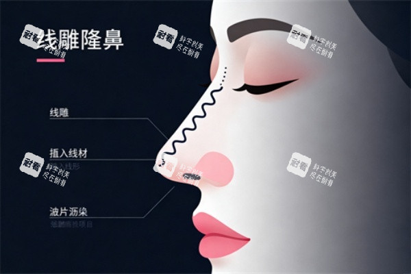 埋线隆鼻卡通展示图