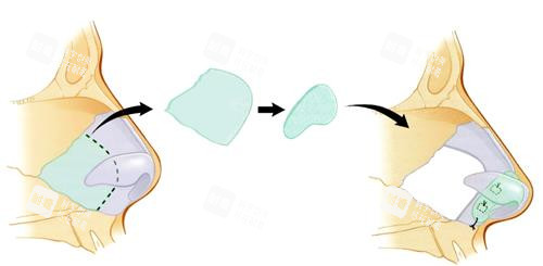 超体隆鼻流程图