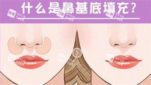 什么是鼻基底填充