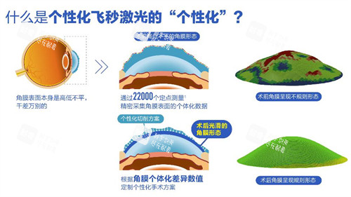 个性化微飞秒手术过程图解