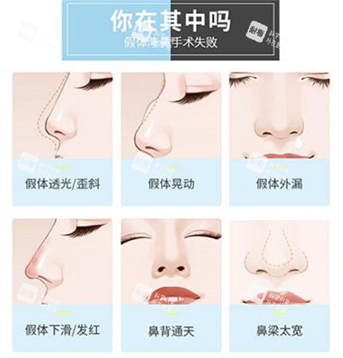 哪些鼻子需要做修复改善