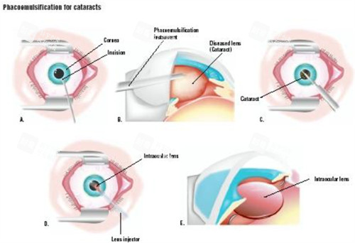 杭州白内障手术价格表，单眼费用含人工晶体3000-20000元，正规医院收费规范无套路