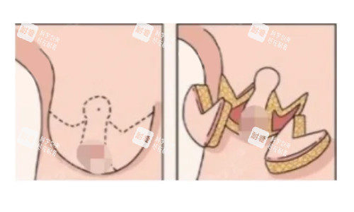 倒T法（标准乳房缩减术）展示