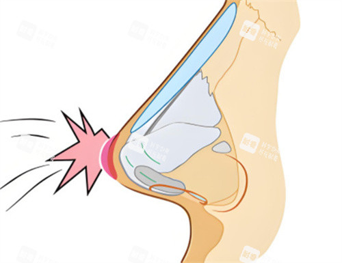 范荣杰做鼻子好是营销出来的嘛？深度解析其“膨体鼻修”技术特色、手术风格及真实口碑