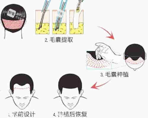 植发过程图解详细
