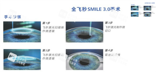 全飞秒3.0手术步骤