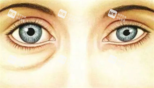 假性眼袋对比展示图