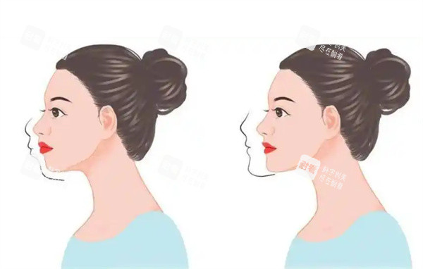 正颌矫正前后对比图