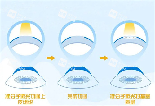 不同的近视手术