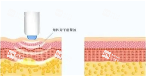 热玛吉项目皮肤剖面图