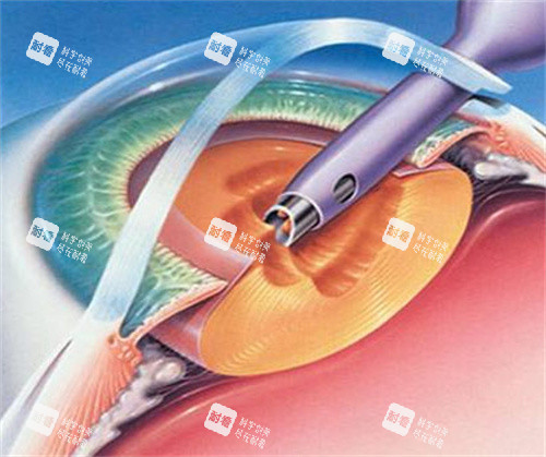 白内障囊外摘除术图片