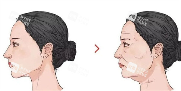拉皮整形手术前后对比
