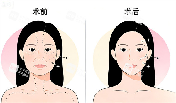 面部拉皮整形手术前后对比