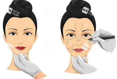 李晓东pst面部提升全脸多少钱？快来了解2026年比较新价格及手术优势、预约方式等关键信息！