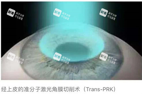 近视眼手术10