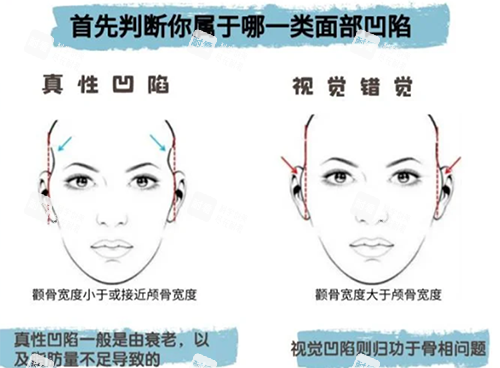 广东深圳龙华罗文医疗美容注射填充，精细化塑形改善面部凹陷问题