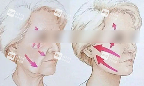 做拉皮手术前后动画图