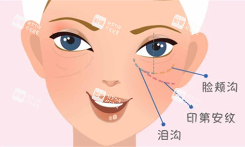 泪沟卡通图