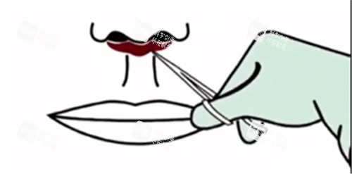 人中缩短手术动画图片