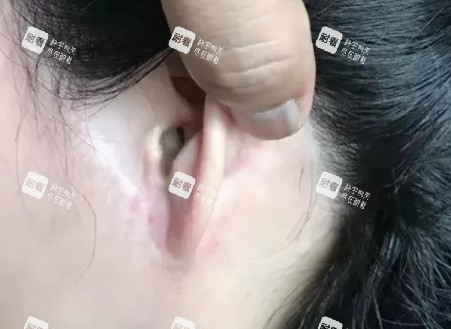 拉皮手术疤痕图