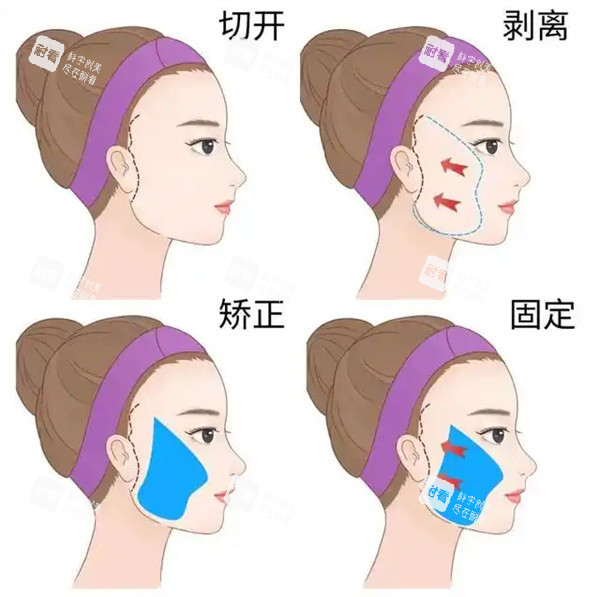 面部拉皮整形手术