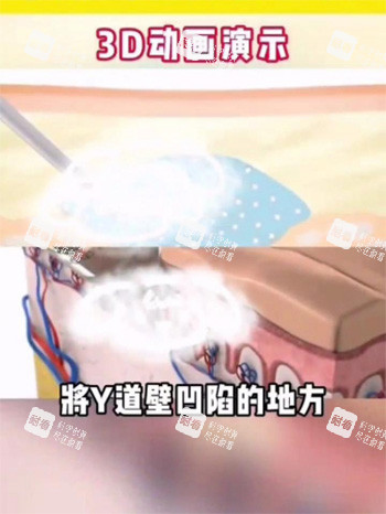 紧缩针注射阴道动画图