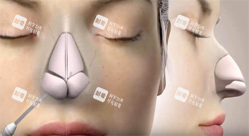隆鼻手术动画图