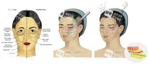 面部提升手术过程