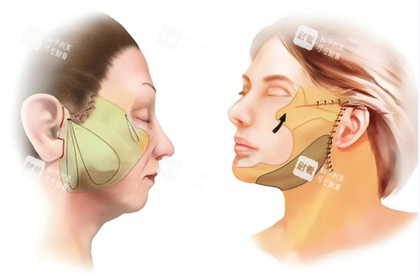 面部提升手术展示厅