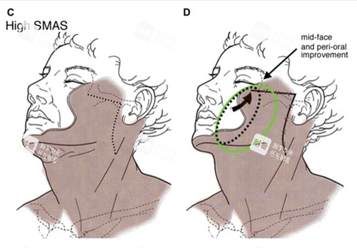 面部提升图示一览