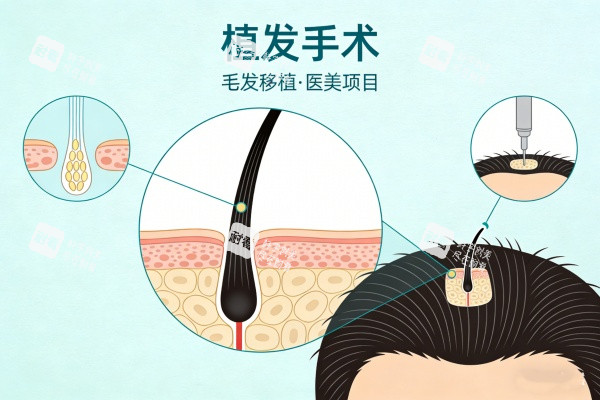 植发手术卡通展示