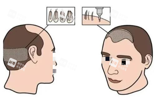 植发成效示意图