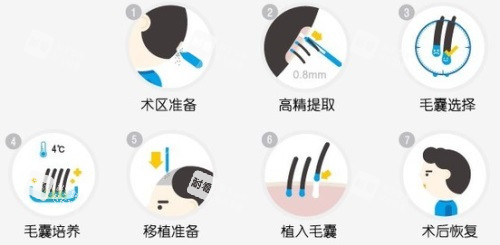 植发过程图解