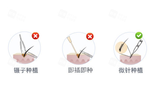 植发技术对比