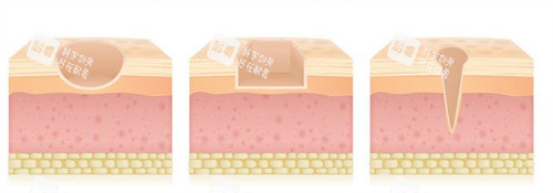 不同疤痕凹陷形状