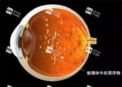 玻璃体混浊