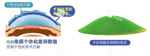 个性化飞秒术后角膜