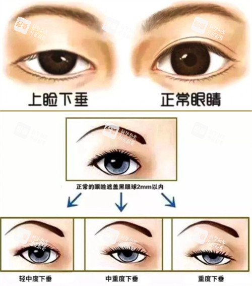 上睑下垂的不同程度